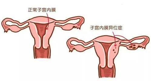 女大学生每月3周痛经想切子宫